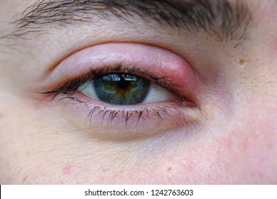 Eye Stye Macro