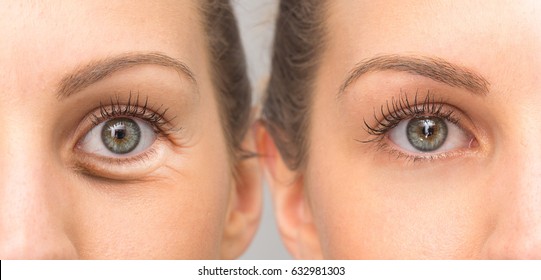 Eye with and without wrinkles, before and after surgery treatment