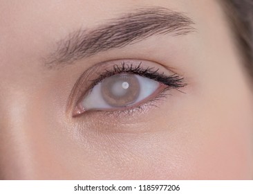 Eye Of A Woman With Cataract And Corneal Opacity