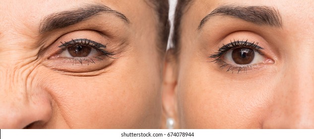 Eye of woman with and without wrinkles before and after cosmetic treatment