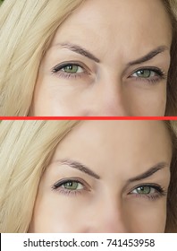 Eye Wrinkles Before And After, Biorevitalization, Botox, Pigment Spots, Freckles, Old Age, Eyes
