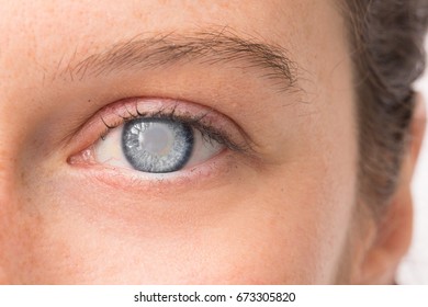 Eye Of Young Girl With Cataract