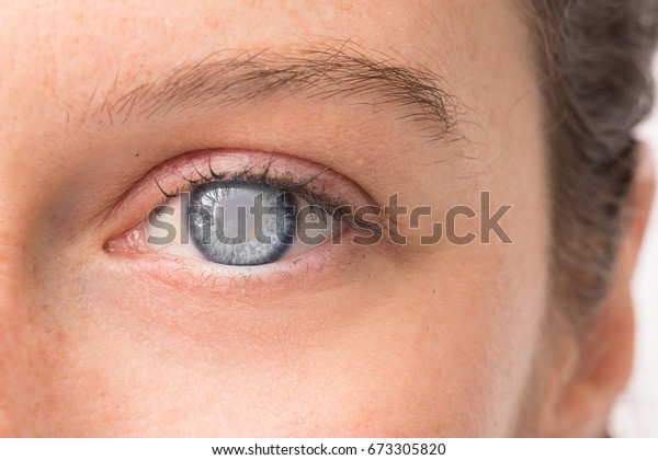 Eye of young girl with\
cataract