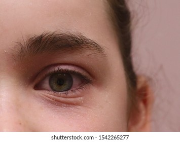 Eyelid Eczema Atopic Dermatitis In An Allergic Female. There Is Edema Swelling, Redness, Dry, Flaking Skin, And Dennie's Lines Wrinkles In The Lower Eyelid.