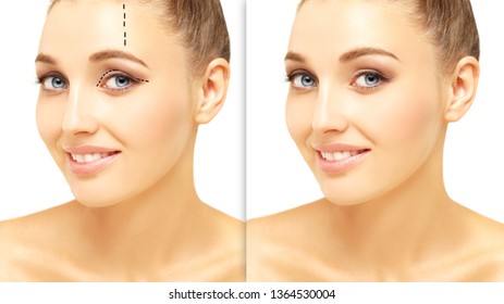 Eyelid Surgery.Brow Lift.upper Eyelids.Forehead Lift.Marking The Face.Perforation Lines On Females Face, Plastic Surgery Concept.