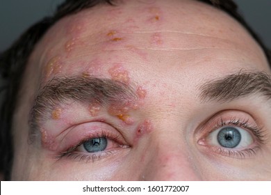 eyes of a man suffering from herpes zoster on the 7th day of illness. inflamed eyelid and eye and forehead blisters during herpes disease. shingles on the face