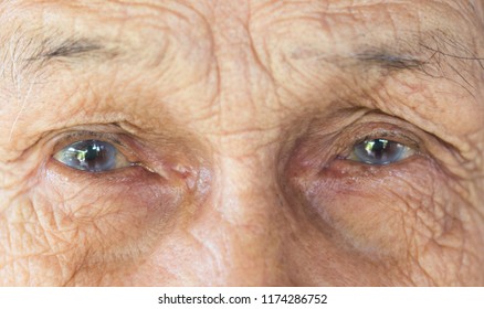 Eyes Of Old Man , Minor Cataract Patient