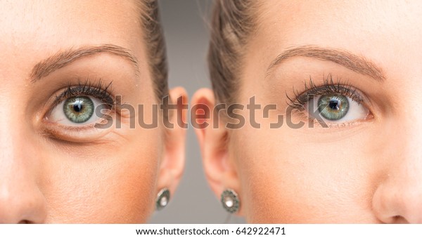 Eyes of woman with and without eye bag before\
and after cosmetic\
treatment