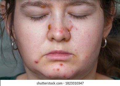 Face Of Adult Woman With Smallpox Disease Has Red Pimples On Skin.