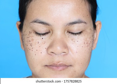 Face Of ASEAN Women That Has Signs Of Laser Freckle Removal On Her Face. The Concept Of Skin Problems In Women.