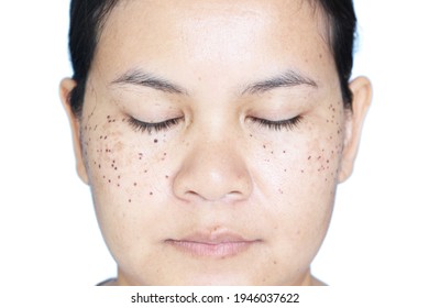 Face Of ASEAN Women That Has Signs Of Laser Freckle Removal On Her Face. The Concept Of Skin Problems In Women.