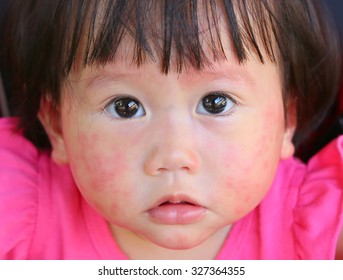 Face Baby Rash, Dermatitis