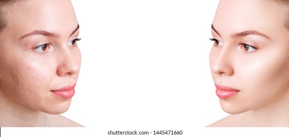 Face of beautiful woman before and after skin treatment and retouch. Copy space. Beautician concept. - Shutterstock ID 1445471660