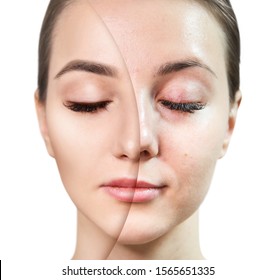 Face Beautiful Woman Before After Skin Stock Photo (Edit Now) 1565651335