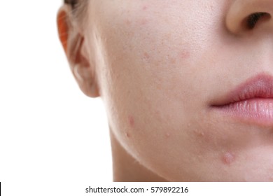 Face of beautiful young woman with problem skin, closeup