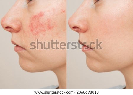 face comparison of a young Caucasian woman suffering from the skin chronic disease rosacea on her face in the acute stage. Before and after treatment. Pink acne. Dermatological problems.   Imagine de stoc © 