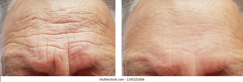 face elderly man forehead wrinkles face before and after procedures