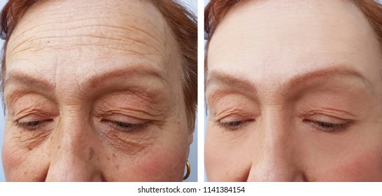 Face Of An Elderly Woman Wrinkles Face Before And After Procedures