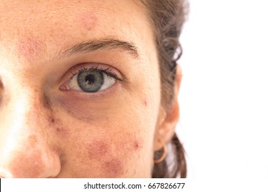 Face Of Girl With Erythema Cutaneous Caused By Sun Exposure