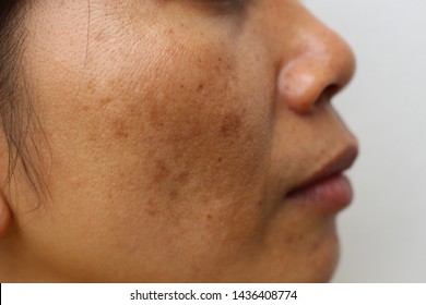 The face of the girl has freckles and large pores - Shutterstock ID 1436408774