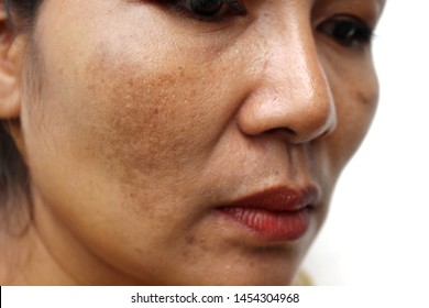The face of the girl has freckles and large pores - Shutterstock ID 1454304968