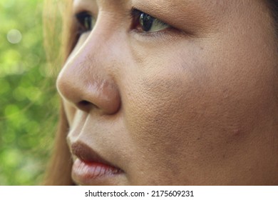 The Face Of The Girl Has Freckles And Large Pores