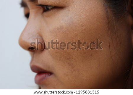 The face of the girl has freckles and large pores