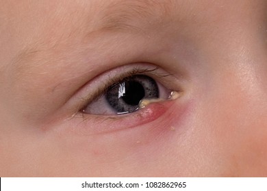 Chalazion Images, Stock Photos & Vectors | Shutterstock