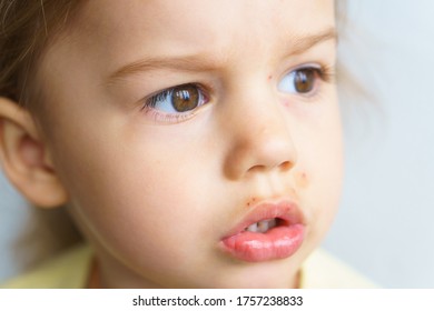 The Face Of A Little Girl With Skin Rashes Is A Close-up View. Treatment Of Rashes, Acne, Pimples Dermatic Diseases, Contagious Mollusks On Skin In Children. Copy Space.