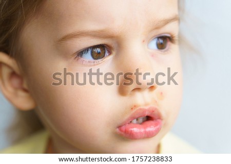 The face of a little girl with skin rashes is a close-up view. Treatment of rashes, acne, pimples dermatic diseases, contagious mollusks on skin in children. Copy space.