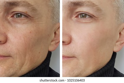 Face Of A Man Before And After The Procedure
