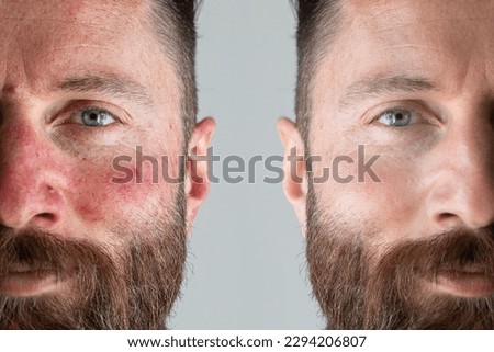Face of a man with flushed cheek skin. Before and after a rosacea laser treatment. Half face with and without couperose