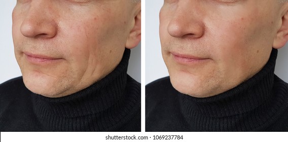 Face Man Wrinkles Before And After