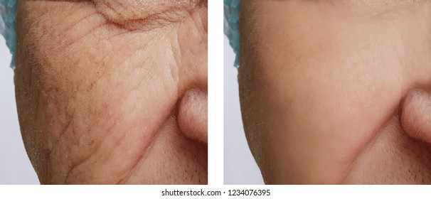 face of an old man wrinkles before and after procedures - Shutterstock ID 1234076395