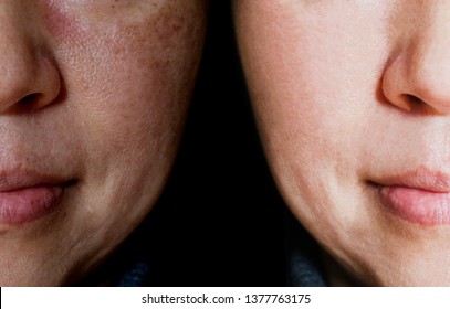 Face With Open Pores And Melasma Before And After Make Up Or Treatment Concept.