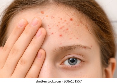 face of a teenage girl with pimples, acne on the skin, portrait of a teen girl, she touches her forehead with her hand
