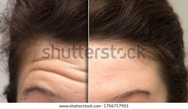 face of a woman before and after a
cosmetic treatment to smooth expression lines. Concept of
anti-aging and rejuvenation cosmetics on forehead
wrinkles