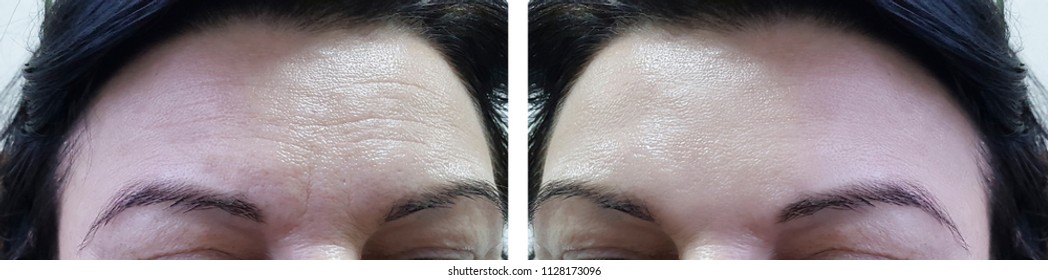 Face Woman Forehead Wrinkles Before And After Cosmetic Procedures