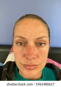 face of a woman with hyper-pigmentation of rare Addison's disease, also known as primary adrenal insufficiency or hypoadrenalism, is a rare disorder of the adrenal glands. this is known as bronzing 