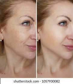 face woman wrinkles   before and after treatments
