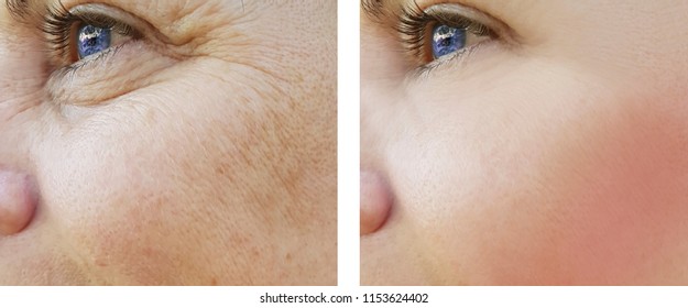 face woman wrinkles eyes before and after procedures, pigmentation