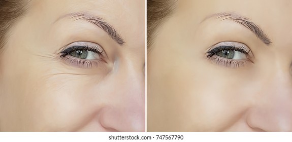 face wrinkles before and after