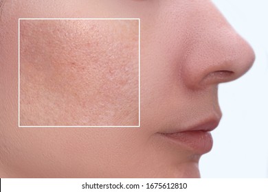 Face Of A Young Woman With An Accent On A Skin Enlarged Pores And Imperfections Treatment, Beauty Treatment Befire And After.