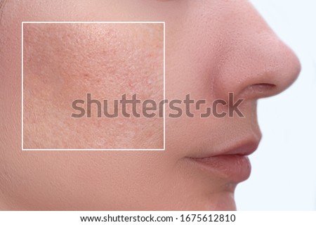 Face of a young woman with an accent on a skin enlarged pores and imperfections treatment, beauty treatment befire and after.