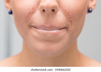 Face Of A Young Woman With Irritation Due To The Use Of The Mask. Excoriation And Pimples Due To Rubbing Of The Protective Mask. Concept Of Dermatology And Skin Problems