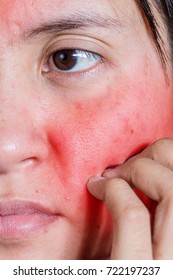 Face Of A Young Woman With Itching And Red Rash. Skin Irritation. Acne Treatment Concept, Closeup.