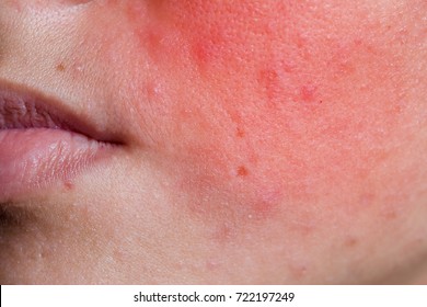 Gesicht einer jungen Frau mit Ausschlag aus einer allergischen Reaktion auf Kosmetika, Nahaufnahme.
