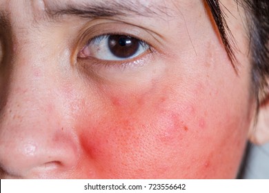 Face Of A Young Woman With Rash From An Allergic Reaction To Cosmetics, Closeup.