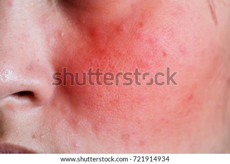 Face of a young woman with rash from an allergic reaction to cosmetics, closeup.