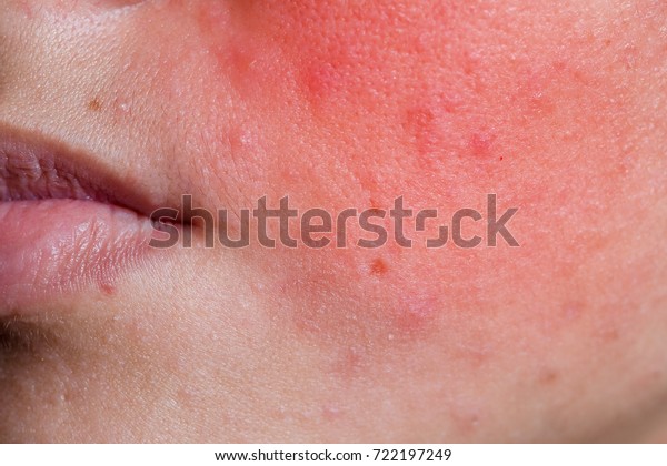 化粧品に対するアレルギー反応から発疹が出る若い女性の顔の接写 の写真素材 今すぐ編集